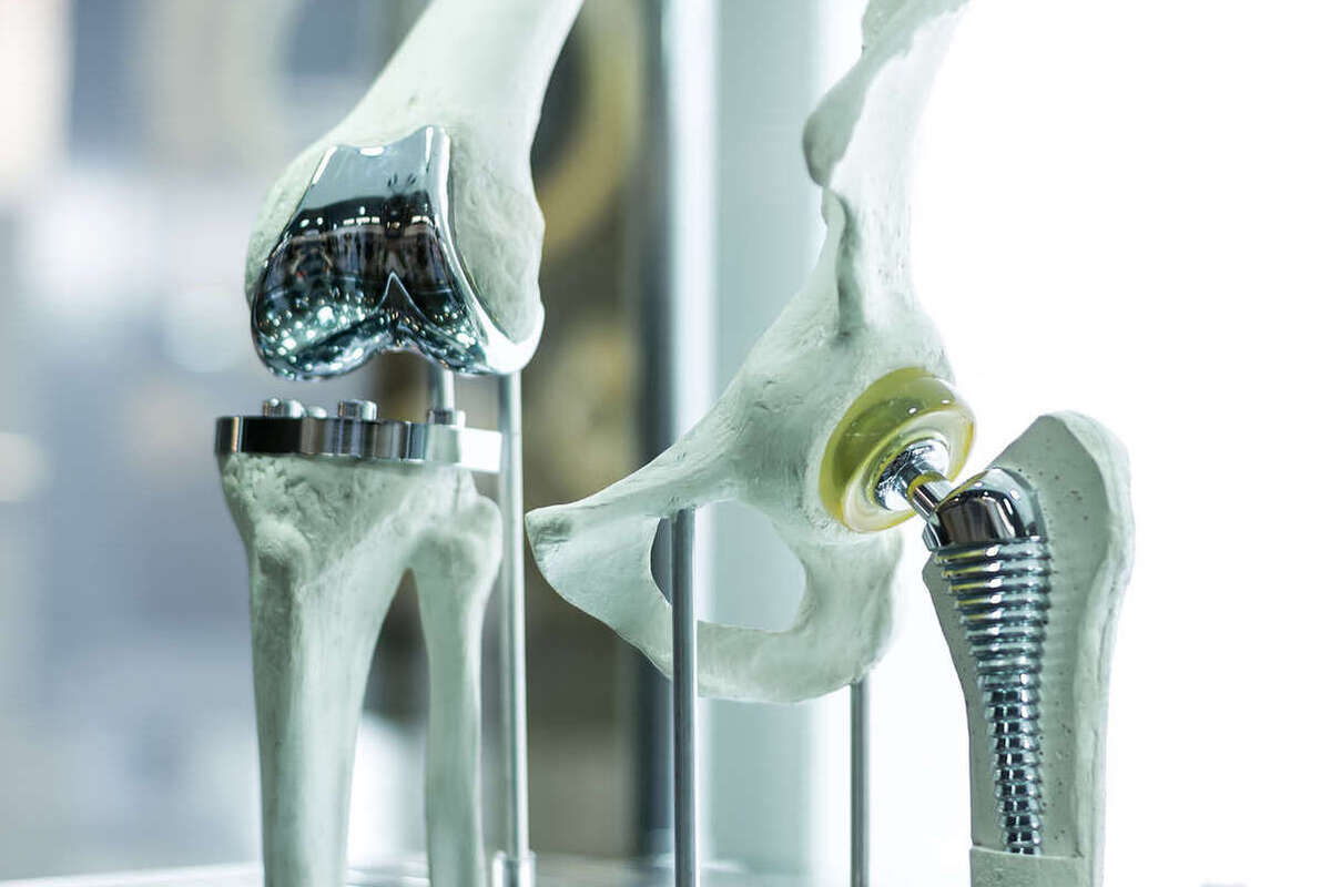 Ученые России изобрели протезы из углеродных волокон, которые срастаются с костью